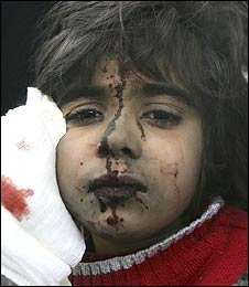 イスラエル空爆で負傷した子供